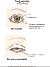 Thumbnail image of: Conjuntivitis