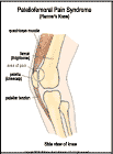 Thumbnail image of: Sndrome de dolor femorrotuliano: ilustracin