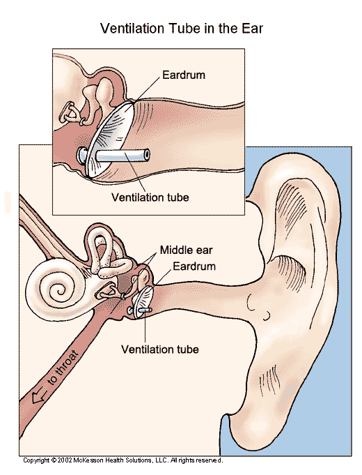 Ventilation Tube in the Ear: Illustration